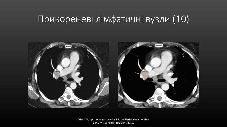 Прикореневі лімфатичні вузли (10) Atlas of lymph node anatomy / ed. M. G. Harisinghani.