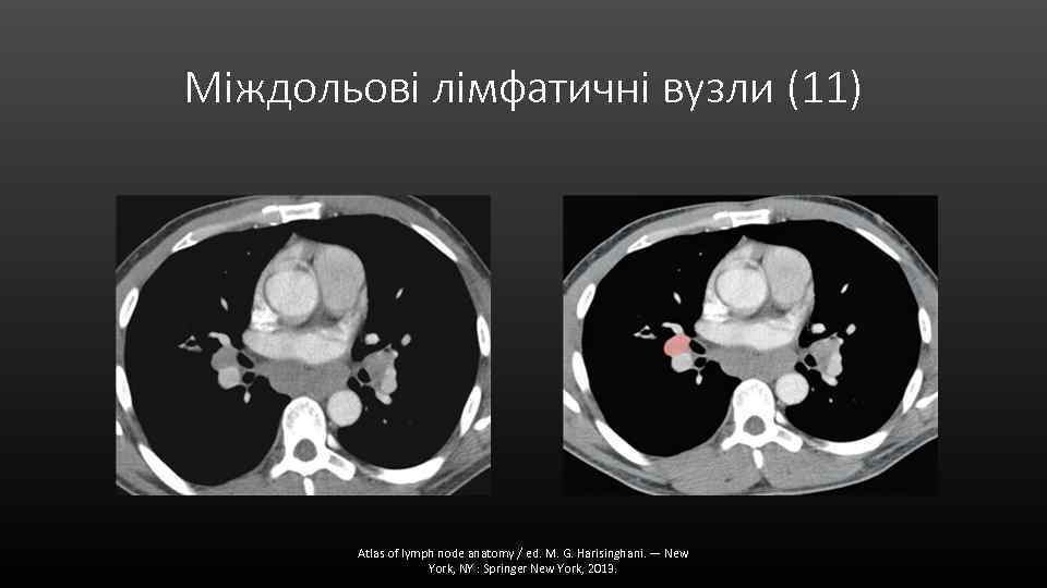 Міждольові лімфатичні вузли (11) Atlas of lymph node anatomy / ed. M. G. Harisinghani.