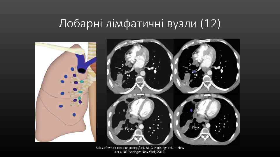 Лобарні лімфатичні вузли (12) Atlas of lymph node anatomy / ed. M. G. Harisinghani.