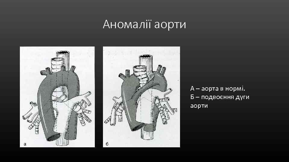 Аномалії аорти А – аорта в нормі. Б – подвоєння дуги аорти 