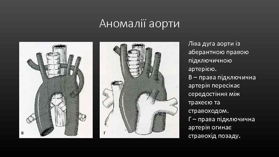 Аномалії аорти Ліва дуга аорти із аберантною правою підключичною артерією. В – права підключична