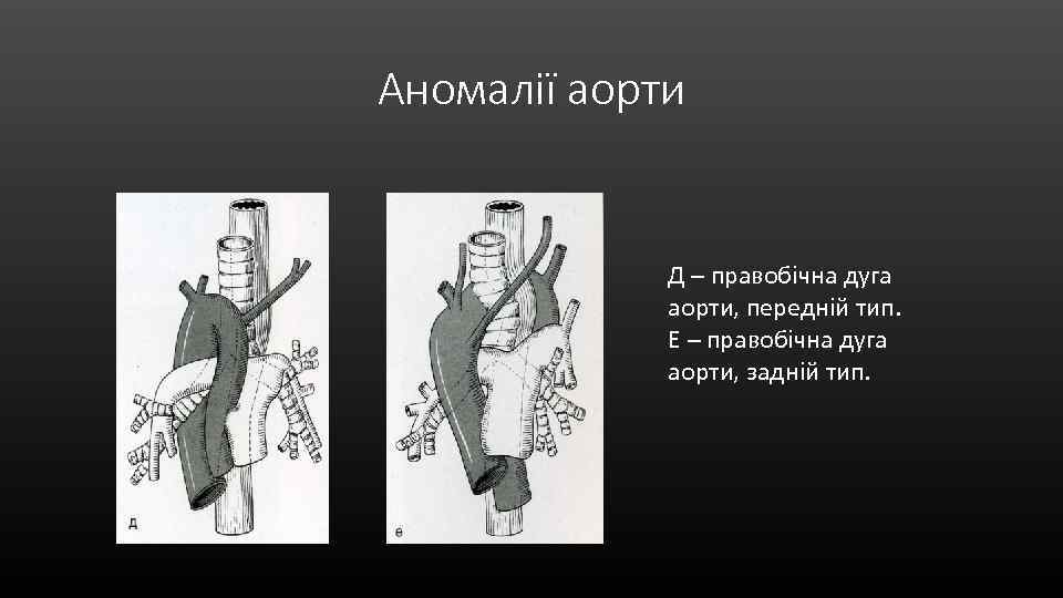 Аномалії аорти Д – правобічна дуга аорти, передній тип. Е – правобічна дуга аорти,