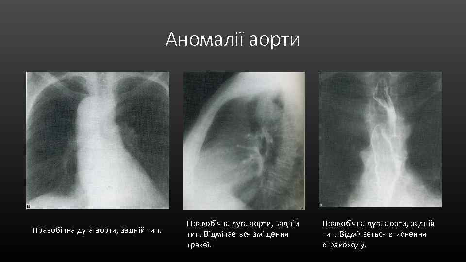 Аномалії аорти Правобічна дуга аорти, задній тип. Відмічається зміщення трахеї. Правобічна дуга аорти, задній