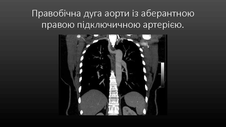 Правобічна дуга аорти із аберантною правою підключичною артерією. 