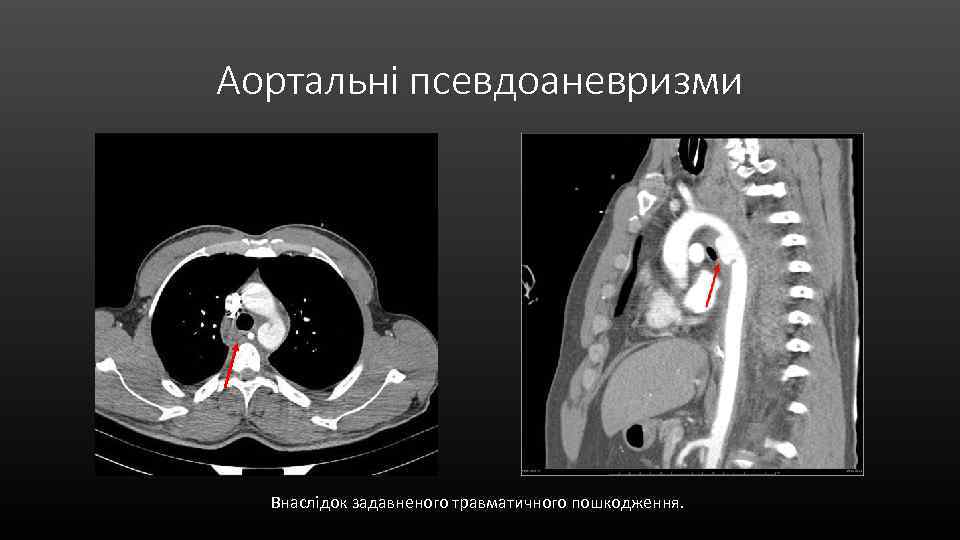 Аортальні псевдоаневризми Внаслідок задавненого травматичного пошкодження. 