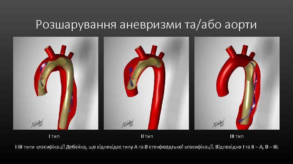 Розшарування аневризми та/або аорти I тип III тип I-III типи класифікації Дебейка, що відповідає