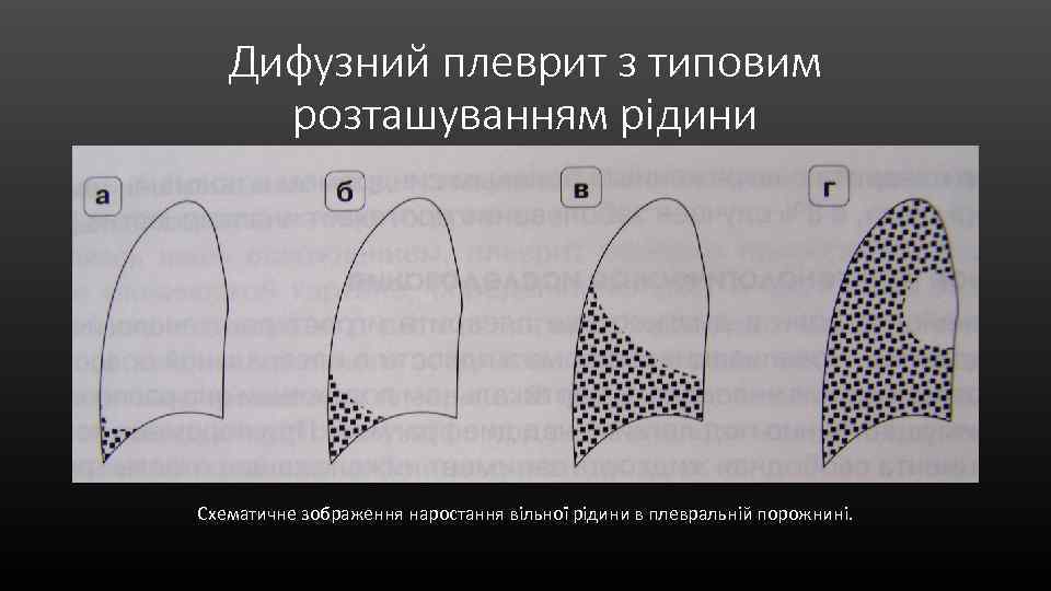 Дифузний плеврит з типовим розташуванням рідини Схематичне зображення наростання вільної рідини в плевральній порожнині.