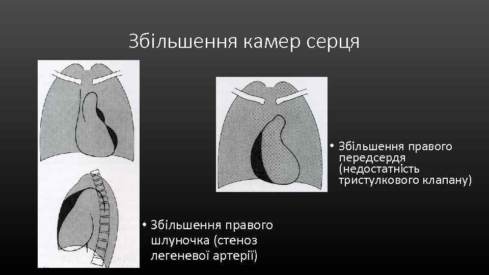 Збільшення камер серця • Збільшення правого передсердя (недостатність тристулкового клапану) • Збільшення правого шлуночка