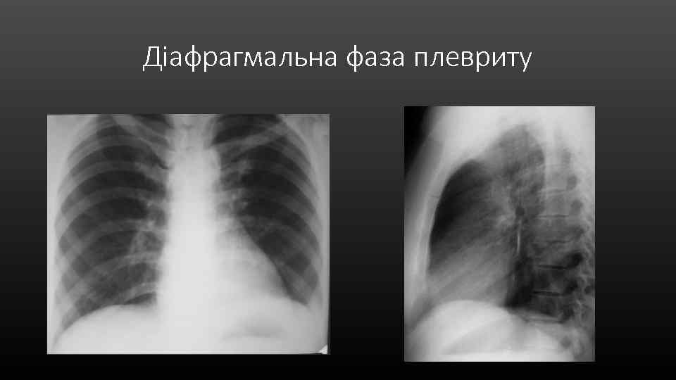 Діафрагмальна фаза плевриту 