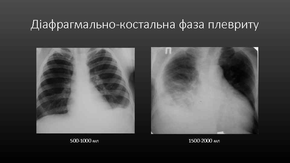 Діафрагмально-костальна фаза плевриту 500 -1000 мл 1500 -2000 мл 