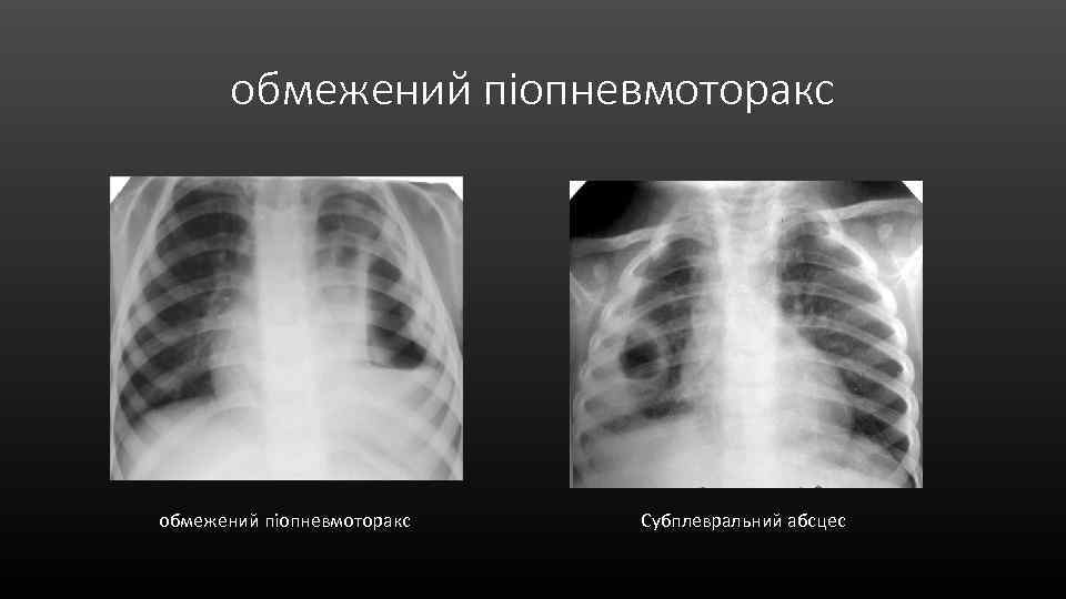 обмежений піопневмоторакс Субплевральний абсцес 