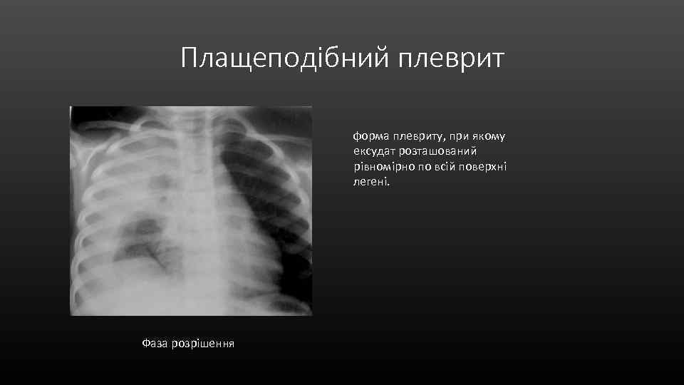 Плащеподібний плеврит форма плевриту, при якому ексудат розташований рівномірно по всій поверхні легені. Фаза