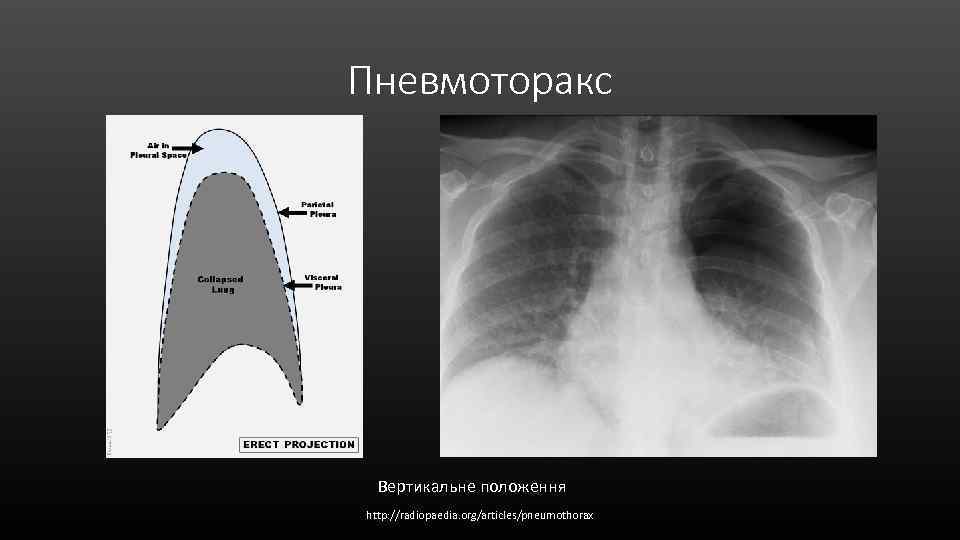 Пневмоторакс Вертикальне положення http: //radiopaedia. org/articles/pneumothorax 