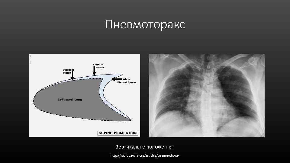 Пневмоторакс Вертикальне положення http: //radiopaedia. org/articles/pneumothorax 