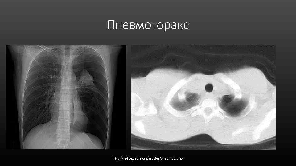 Пневмоторакс http: //radiopaedia. org/articles/pneumothorax 