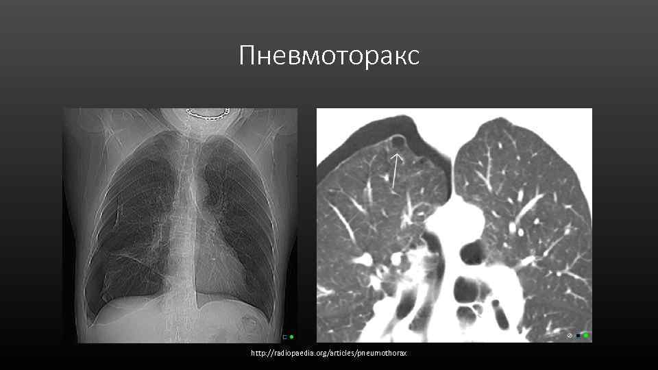 Пневмоторакс http: //radiopaedia. org/articles/pneumothorax 