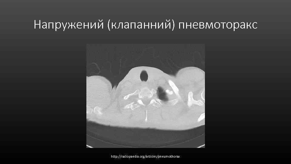 Напружений (клапанний) пневмоторакс http: //radiopaedia. org/articles/pneumothorax 