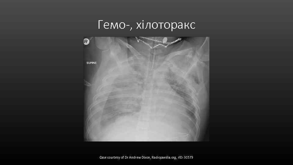 Гемо-, хілоторакс Case courtesy of Dr Andrew Dixon, Radiopaedia. org, r. ID: 31573 