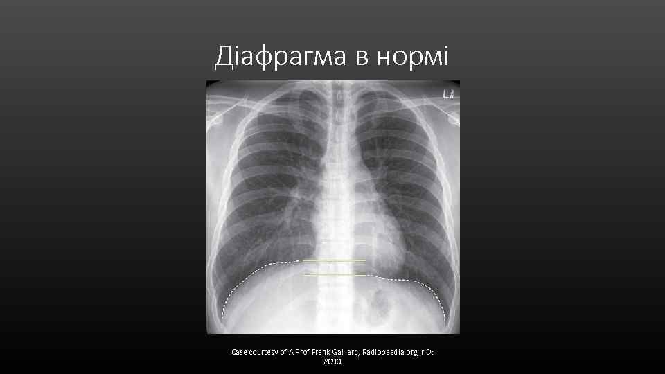 Діафрагма в нормі Case courtesy of A. Prof Frank Gaillard, Radiopaedia. org, r. ID: