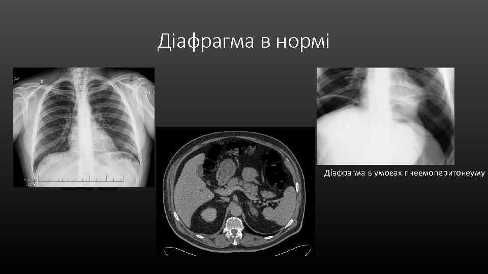 Діафрагма в нормі Діафрагма в умовах пневмоперитонеуму 