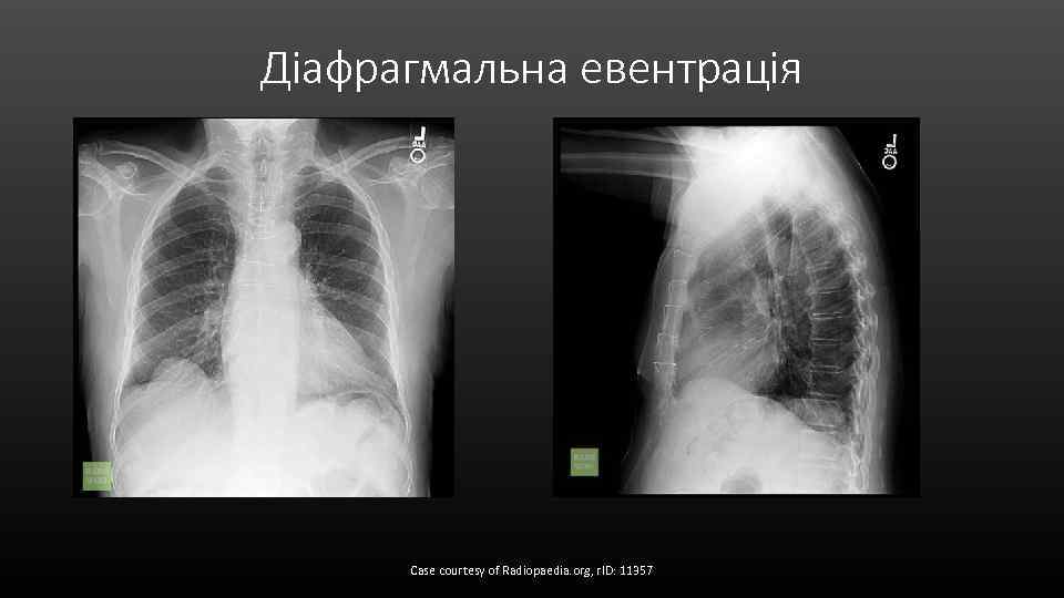 Діафрагмальна евентрація Case courtesy of Radiopaedia. org, r. ID: 11357 