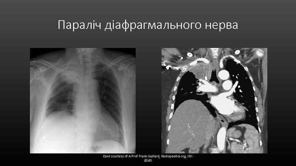 Параліч діафрагмального нерва Case courtesy of A. Prof Frank Gaillard, Radiopaedia. org, r. ID: