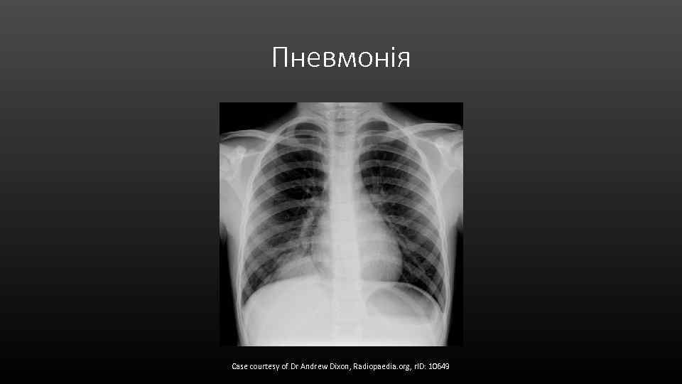 Пневмонія Case courtesy of Dr Andrew Dixon, Radiopaedia. org, r. ID: 10649 