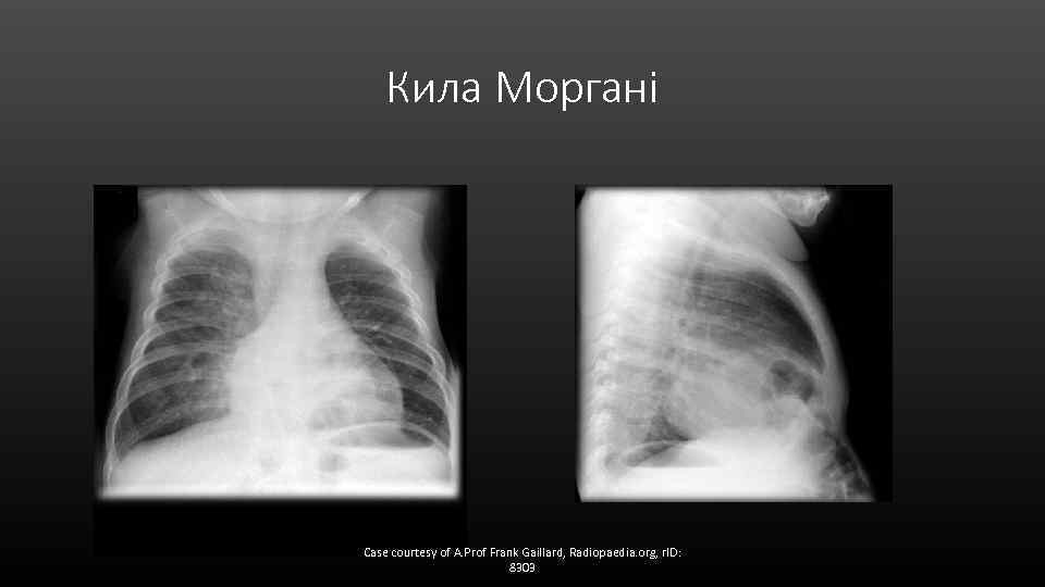 Кила Моргані Case courtesy of A. Prof Frank Gaillard, Radiopaedia. org, r. ID: 8303