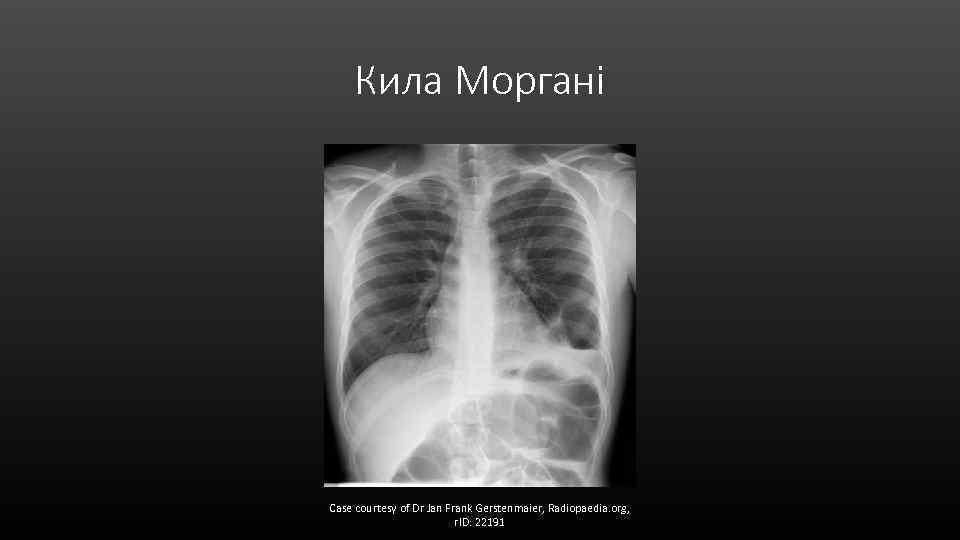 Кила Моргані Case courtesy of Dr Jan Frank Gerstenmaier, Radiopaedia. org, r. ID: 22191