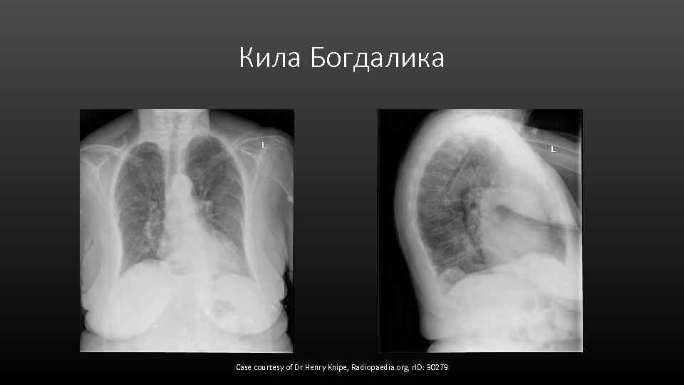 Кила Богдалика Case courtesy of Dr Henry Knipe, Radiopaedia. org, r. ID: 30279 