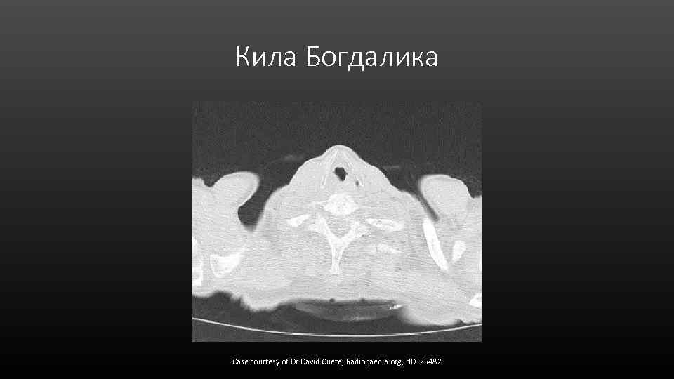 Кила Богдалика Case courtesy of Dr David Cuete, Radiopaedia. org, r. ID: 25482 