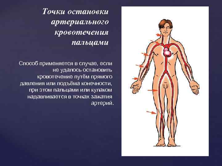 Точки остановки артериального кровотечения пальцами Способ применяется в случае, если не удалось остановить кровотечение
