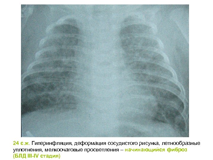 Усиление сосудистого рисунка