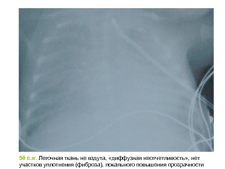 50 с. ж. Легочная ткань не вздута, «диффузная неотчетливость» , нет участков уплотнения (фиброза),