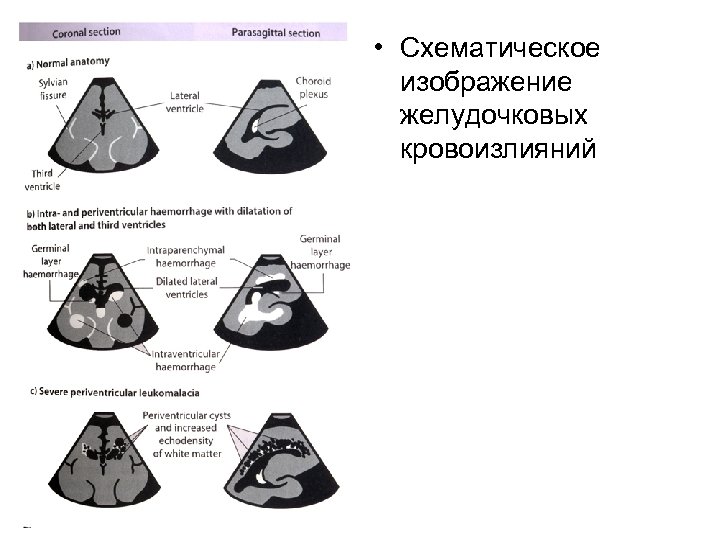  • Схематическое изображение желудочковых кровоизлияний 