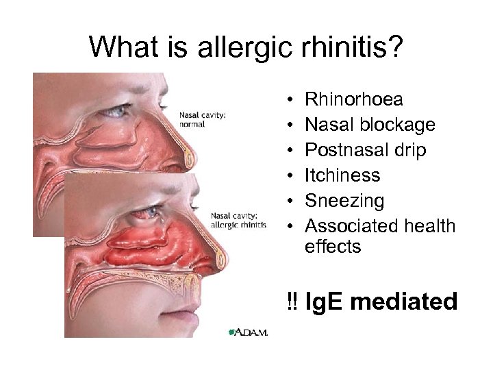 What is allergic rhinitis? • • • Rhinorhoea Nasal blockage Postnasal drip Itchiness Sneezing