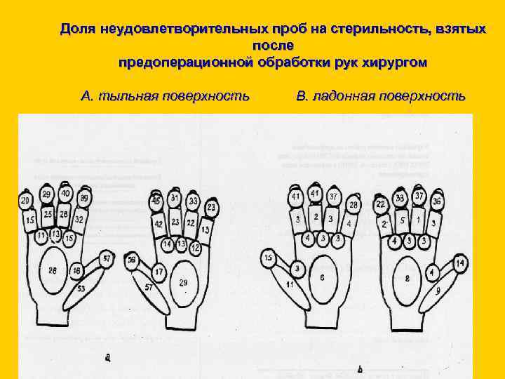 Доля неудовлетворительных проб на стерильность, взятых после предоперационной обработки рук хирургом А. тыльная поверхность