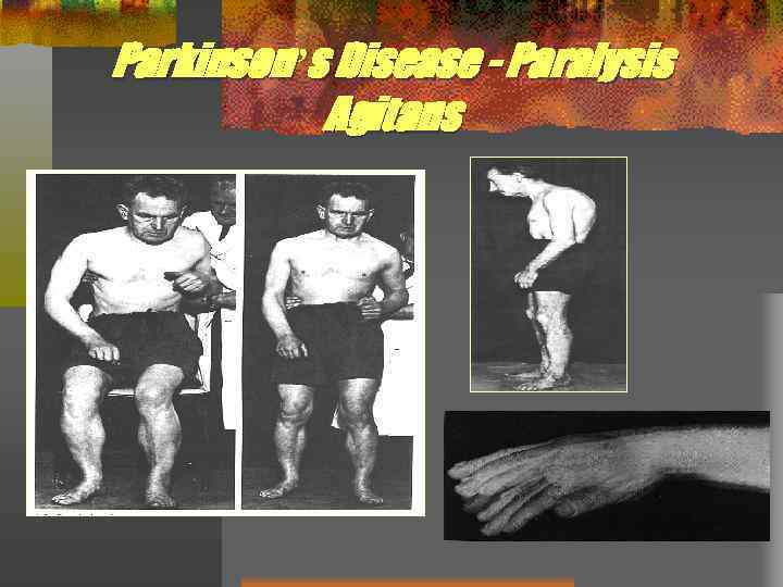 Parkinson’s Disease - Paralysis Agitans 