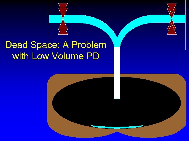Dead Space: A Problem with Low Volume PD 