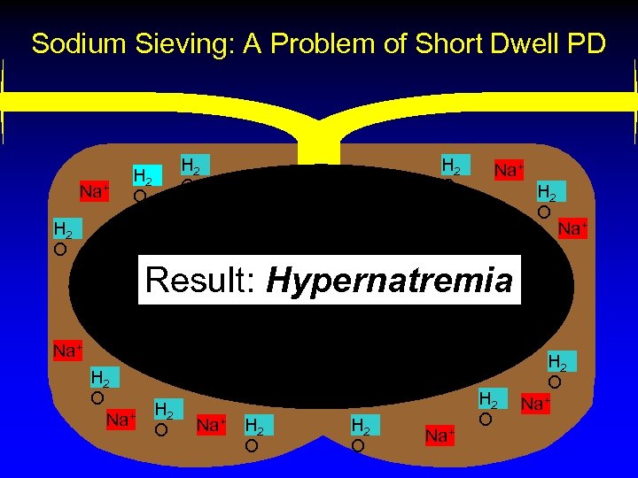 Sodium Sieving: A Problem of Short Dwell PD Na+ H 2 O Na+ H