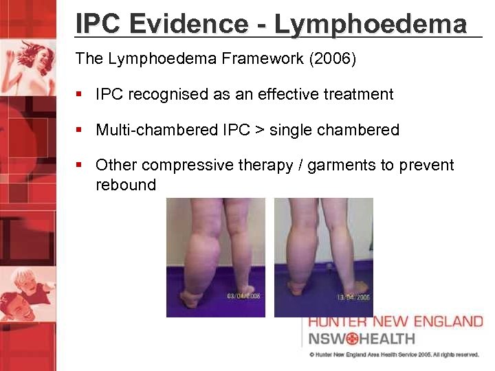 IPC Evidence - Lymphoedema The Lymphoedema Framework (2006) § IPC recognised as an effective