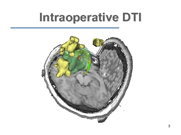 Intraoperative DTI 3 