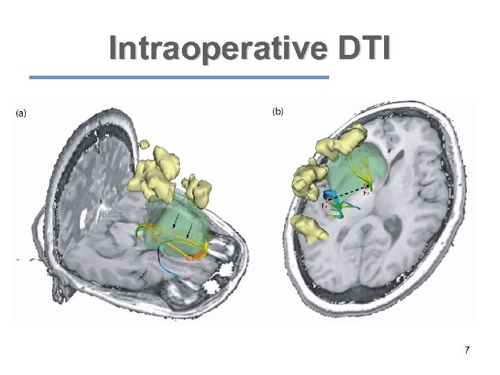 Intraoperative DTI 7 