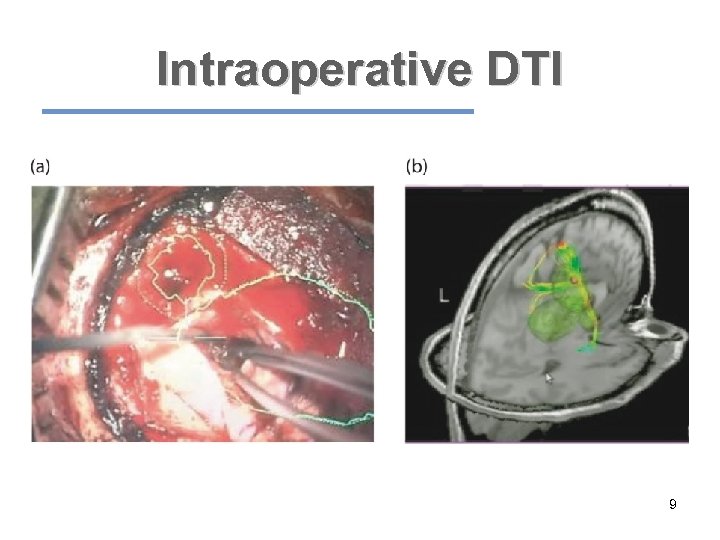 Intraoperative DTI 9 