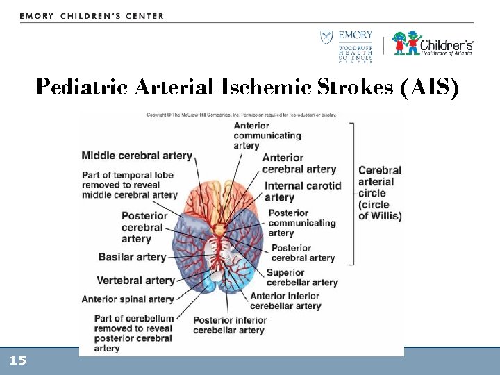 Pediatric Arterial Ischemic Strokes (AIS) 15 