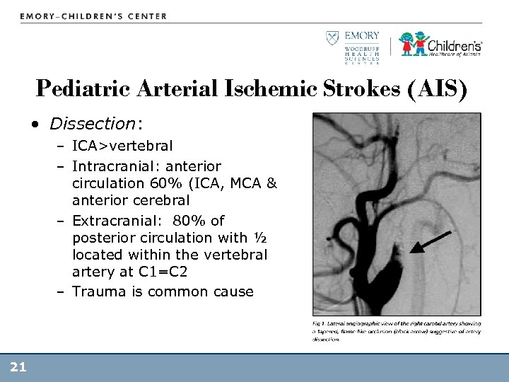 Pediatric Arterial Ischemic Strokes (AIS) • Dissection: – ICA>vertebral – Intracranial: anterior circulation 60%