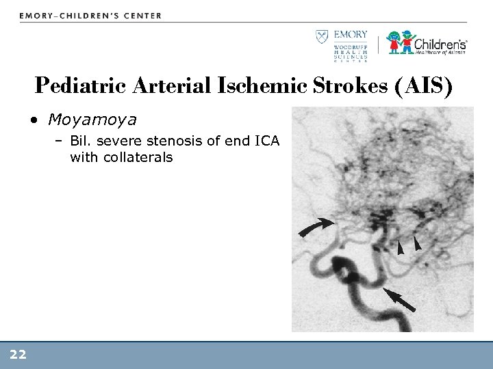 Pediatric Arterial Ischemic Strokes (AIS) • Moyamoya – Bil. severe stenosis of end ICA