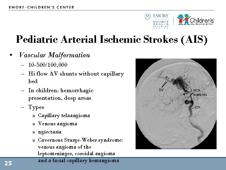 Pediatric Arterial Ischemic Strokes (AIS) • Vascular Malformation – 10 -500/100, 000 – Hi