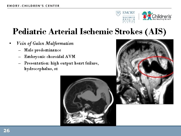 Pediatric Arterial Ischemic Strokes (AIS) • Vein of Galen Malformation – Male predominance –