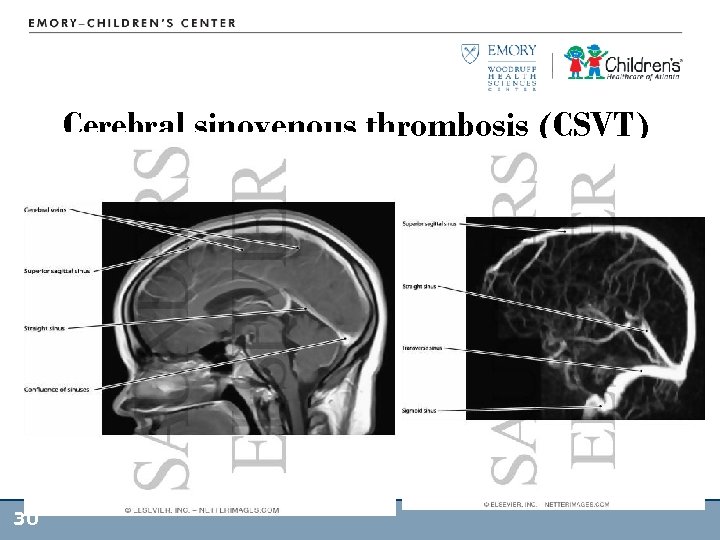 Cerebral sinovenous thrombosis (CSVT) 30 